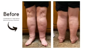 Before-Lymphedema-Before-and-After-1024x576