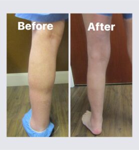 lymphedema-944x1024