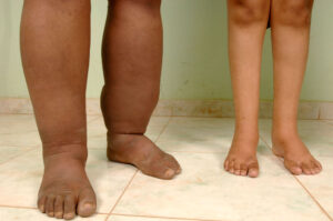 CT3C5D Congenital Diseases Edema Feet